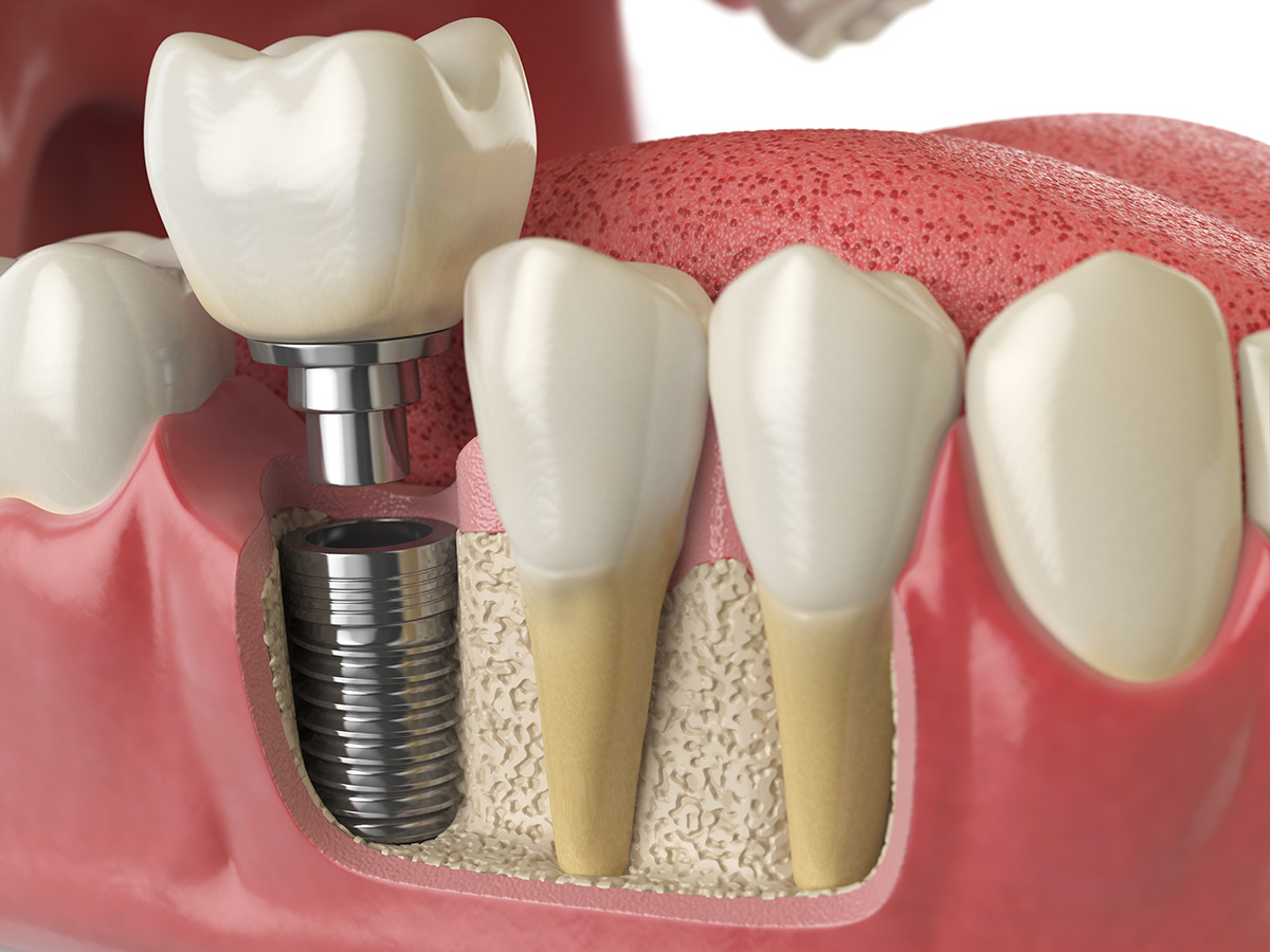 impianto-dentale-spazio-dental-3d impianto-dentale-spazio-dental-3d