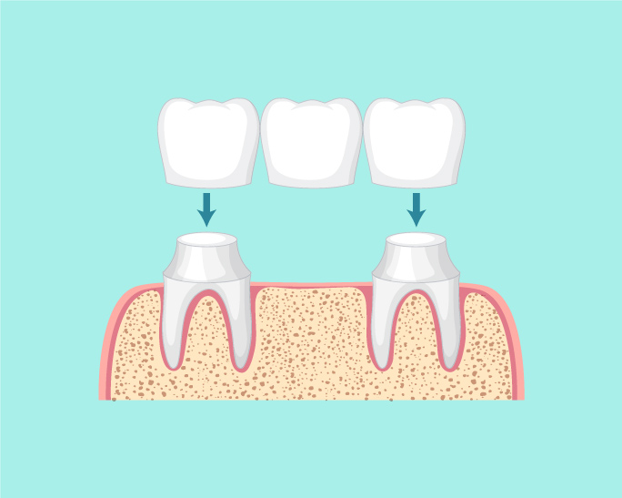 ponte-dentale-centro-odontoiatrico-spazio-dental ponte-dentale-centro-odontoiatrico-spazio-dental