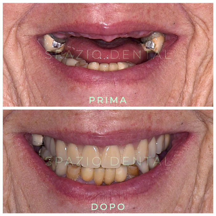 Protesi-Toronto-Bridge-Caso-1-Spazio-Dental