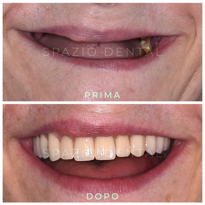 Protesi-Toronto-Bridge-Caso-2-Spazio-Dental