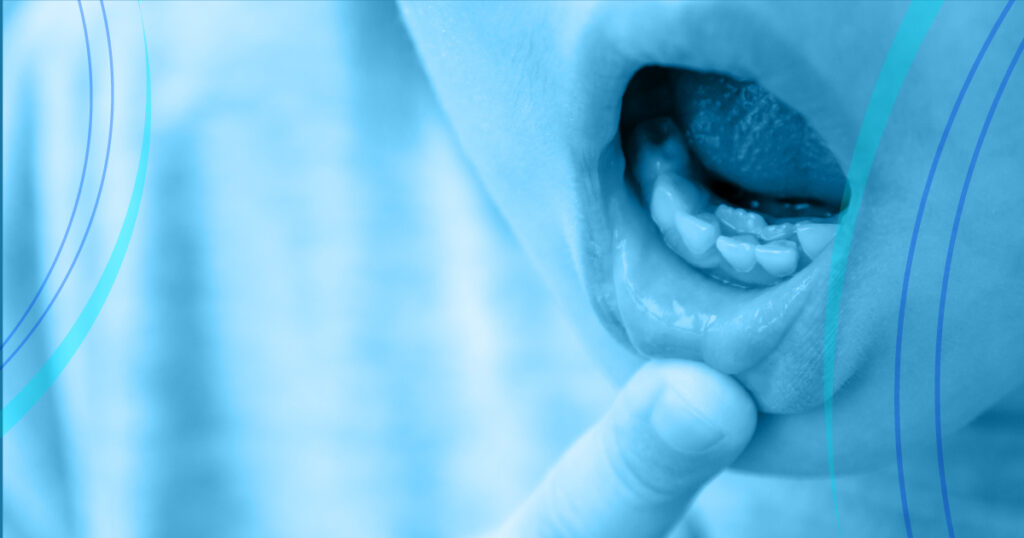 La mancata caduta dei denti da latte è spesso causa di preoccupazione per i genitori. Ma cosa succede se i denti da latte non cadono? Leggi l'articolo.