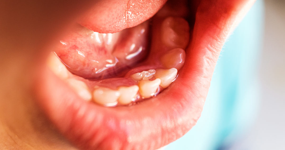 spazio-dental-blog-denti-da-latte-01
