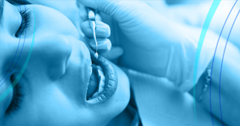 L’otturazione dentale è una delle procedure più comuni per restaurare i denti danneggiate dalle carie. Leggi il nuovo articolo!