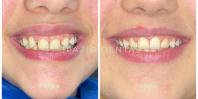 spazio-dental-casi-clinici spazio-dental-casi-clinici