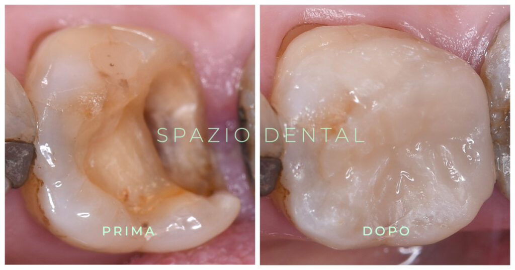 spazio-dental-casi-clinici-intarsi-01-1